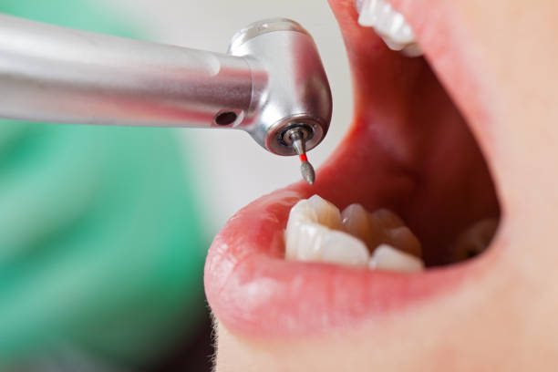 Best Emergency Tooth Extraction in Coarsegold, CA
